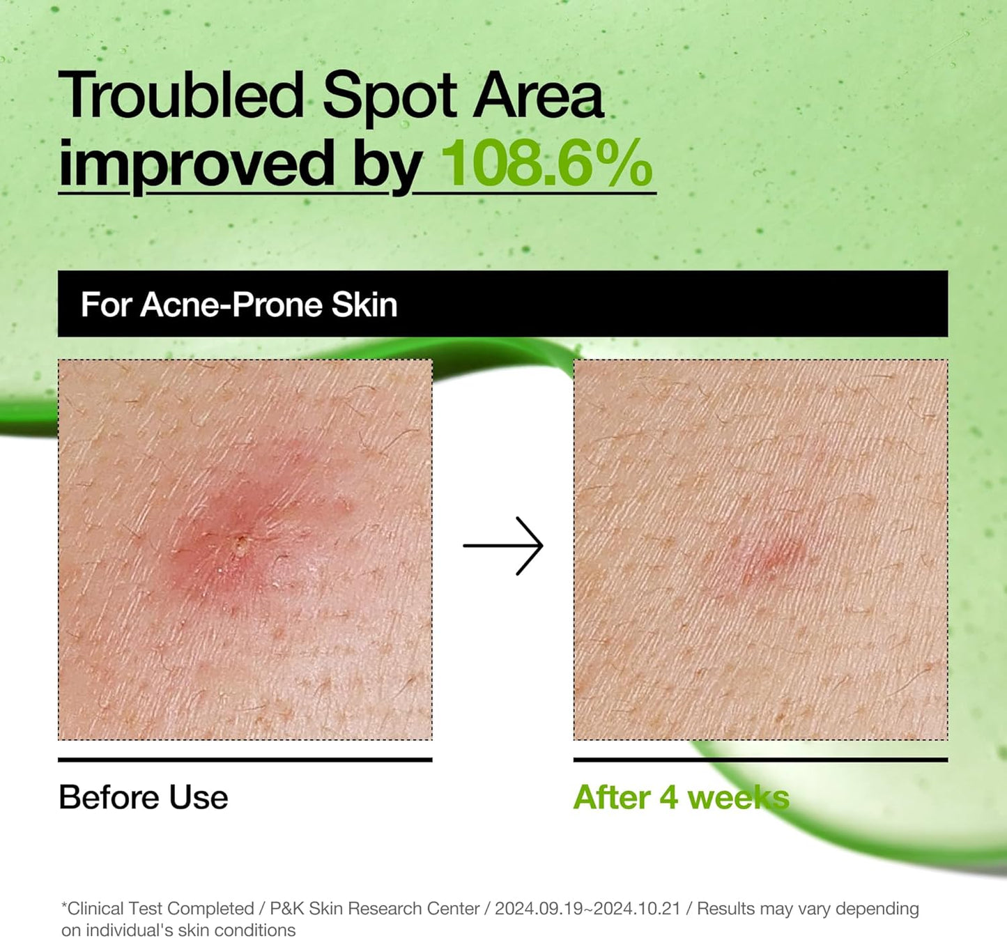 Anua - Azelaic Acid 10 Hyaluron Redness Soothing Serum 30ml